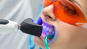 Diş Beyazlatma Fiyatları